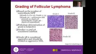 Follicular Lymphoma and other Indolent Lymphomas