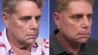 Removal of Hanging "Turkey" Neck in a Man | Review of Dr. Steiger